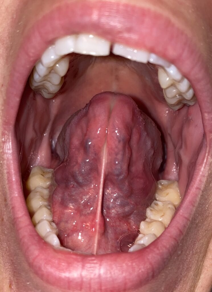 A close up of the mouth with an open tongue