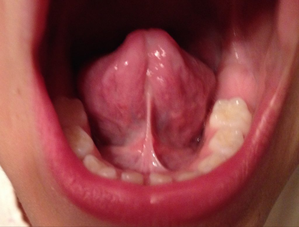Example of tethered oral tissues